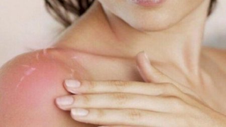 “Yayda sağlam insanların belə ehtiyatlı davranması vacibdir” – Həkim